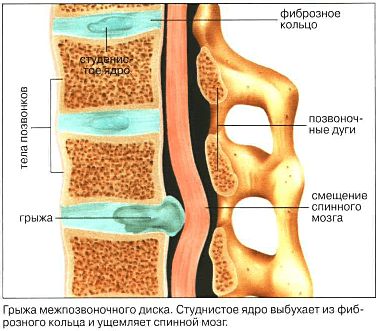 Грижа диска. Протрузія