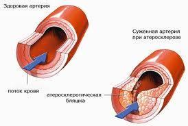 Атеросклероз