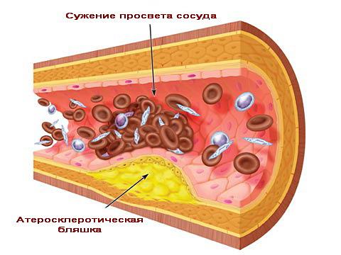 Атеросклероз