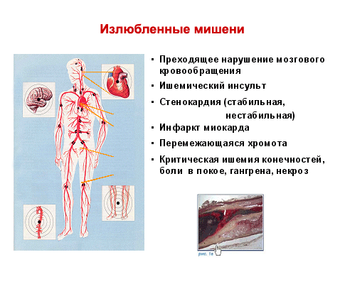 Атеросклероз